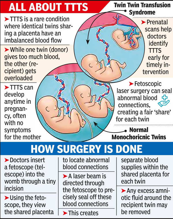 Laser surgery in womb heals twins’ rare illness