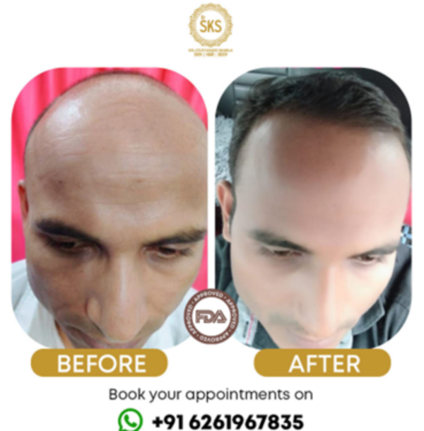 Advt Dr Sks Hair Booster A Non Surgical Hair Growth Treatment Helping