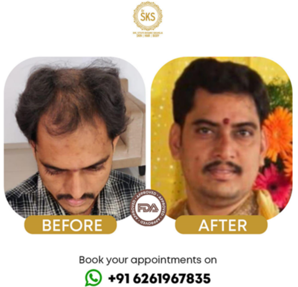 ADVT Dr SKS Hair Booster, a nonsurgical hair growth treatment helping