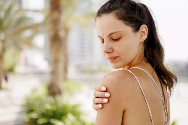 Heat rash: How to spot it and what to do | - Times of India