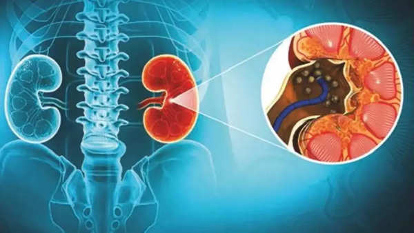 simple-lifestyle-changes-to-avoid-kidney-stones