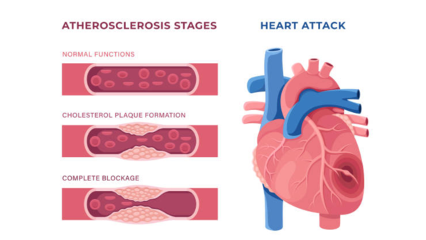 High BP (4)