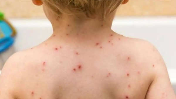 MPOX Virus: ‘deadliest’ mpox variant spreads in a couple of african nations; know indicators and signs | – Occasions of India