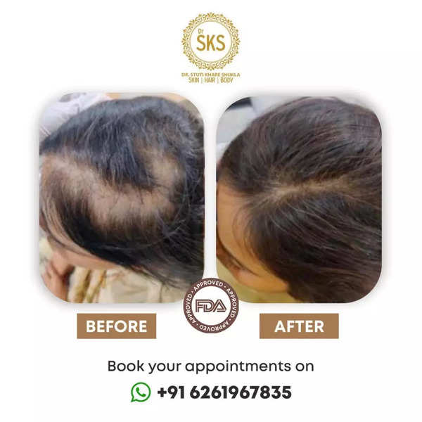 Advt Dr Sks Hair Booster The Ultimate Non Surgical Hair Growth