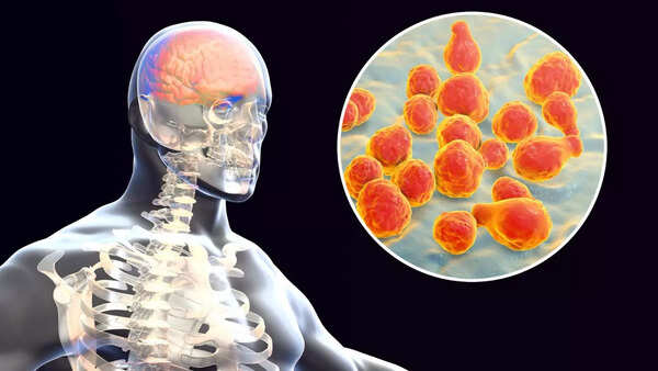 Meningitis
