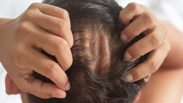 Early balding (1)