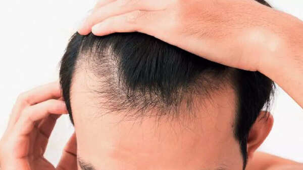 Early balding (2)