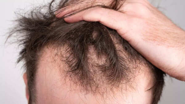 Early balding (3)