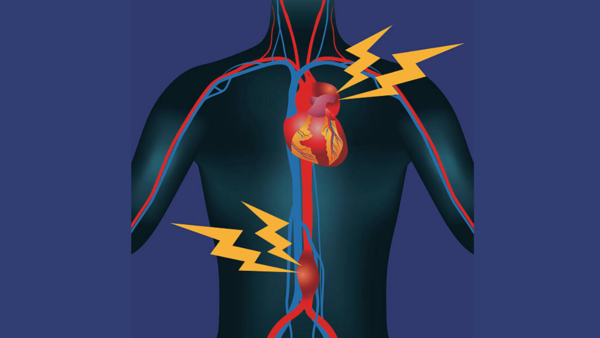 Extreme exercise and the potential cardiovascular risks