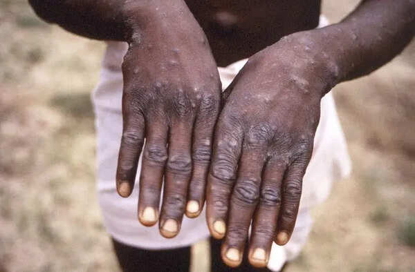 Symptoms Of Mpox