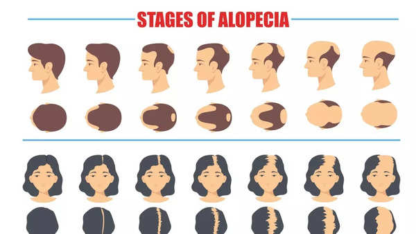 stages of alopecia