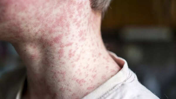 measles 3