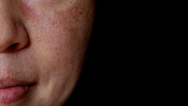 Hyperpigmentation during pregnancy