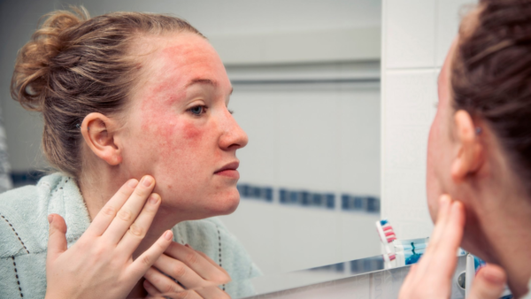 Facial hives after pregnancy birth
