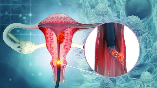 cervical cancer 2