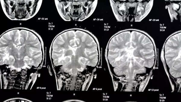 brain injuries