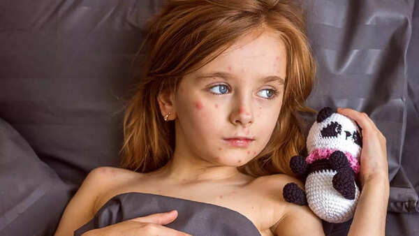 Measles (3)