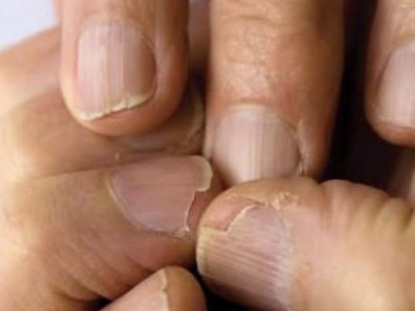 Brittle nails