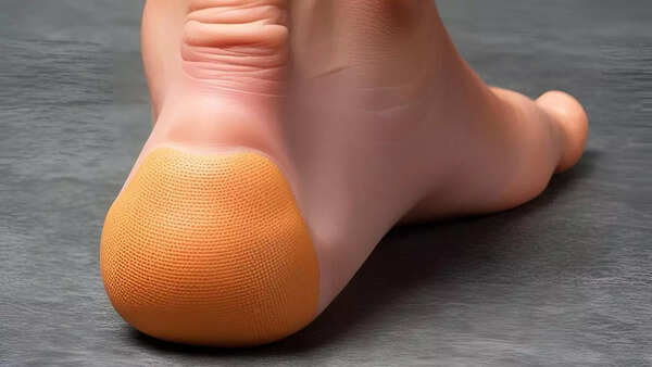 Calcaneus