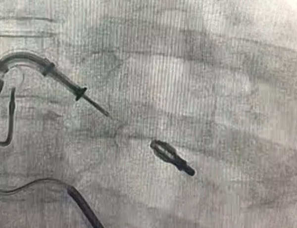 All about Complex High Risk Indicated Percutaneous Coronary ...