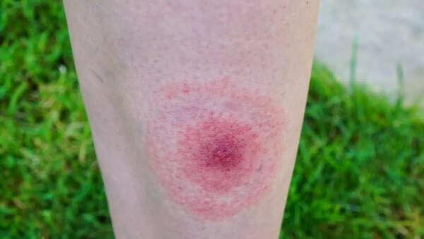 Lyme (2)