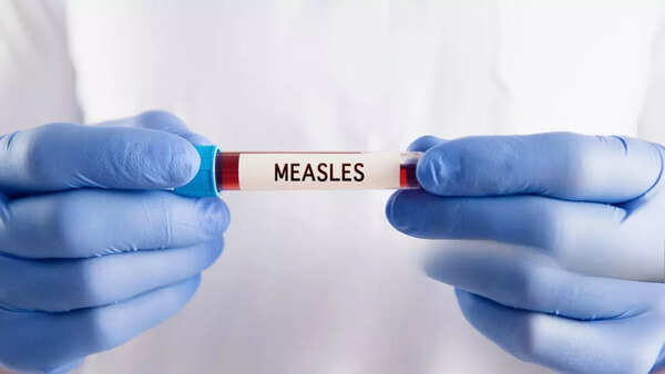 Measles case detected in Washington DC