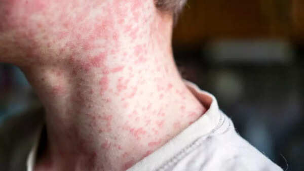 Image credits: iStock Symptoms of measles