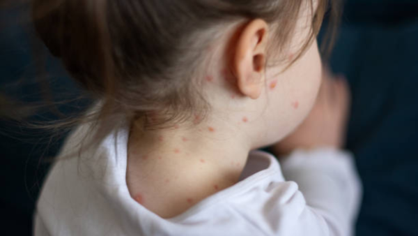 measles (1)
