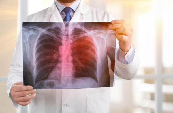 Lung cancer cases