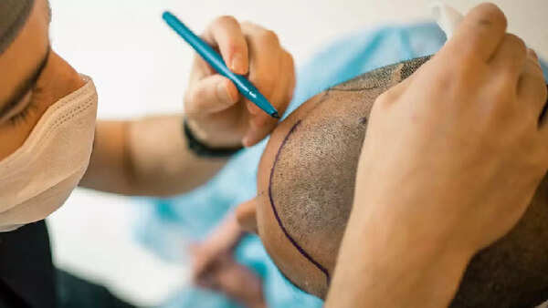 Representative image Hair Transplant