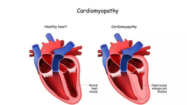 cardiomyopathy