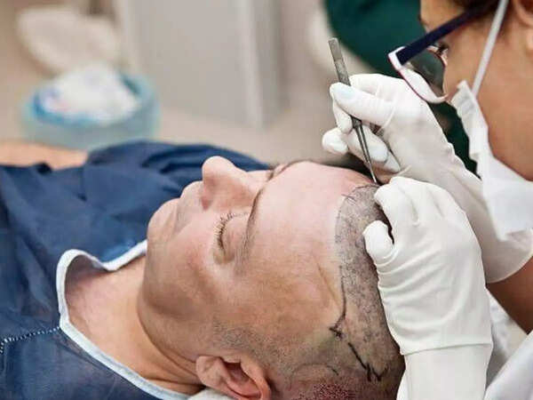 hair transplants