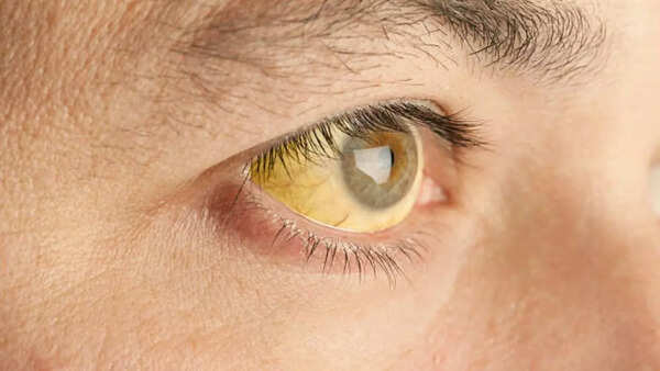 Image credits: Getty Images Yellowing of the skin and eyes
