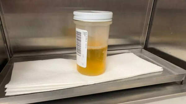 Image credits: Getty Images Dark urine and pale stool