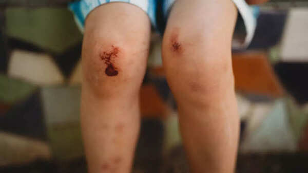 Image credits: Getty Images Body bruising and bleeding more rapidly