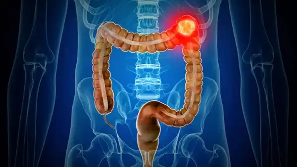 Bowel cancer (1)