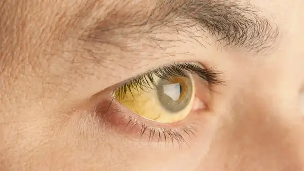 JAUNDICE