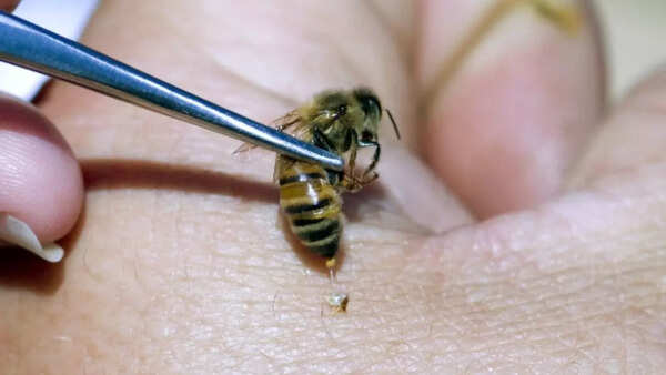 Bee venom therapy – Eastern Europe and China