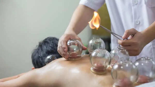 Fire cupping – China and Middle East
