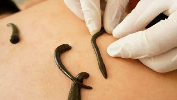 Leech therapy – India and Russia