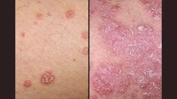 Source: Canva What is psoriasis