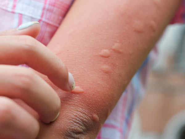 Mosquito bites during travel or the monsoon season