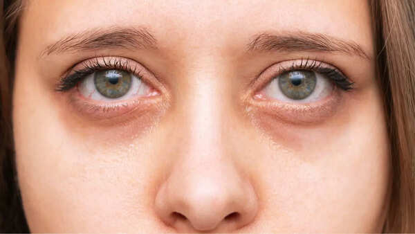 Dark circles under your eyes