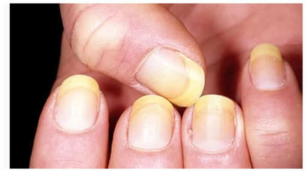 Yellow nails are often caused by a fungal infection, especially if the nails become thick, brittle, or start to crumble. Yellow Nails