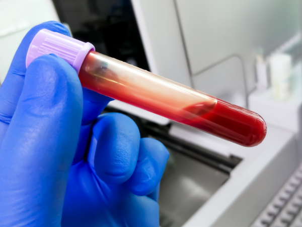 Blood Tube Anemia Test