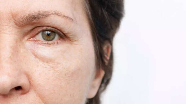 Fatty liver face (1)