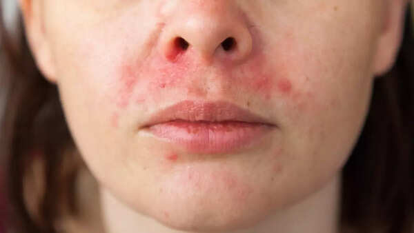 Fatty liver face (3)