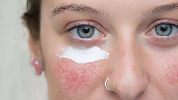 Acne (4)