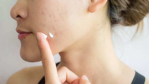 Acne (3)