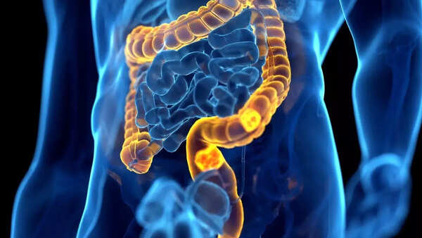Colon cancer sees alarming rise in young adults; Scientists blame this popular food habit Colon cancer sees alarming rise in young adults; Scientists blame this popular food habit
